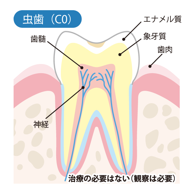 虫歯（C0）