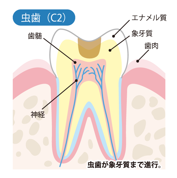 虫歯（C2）