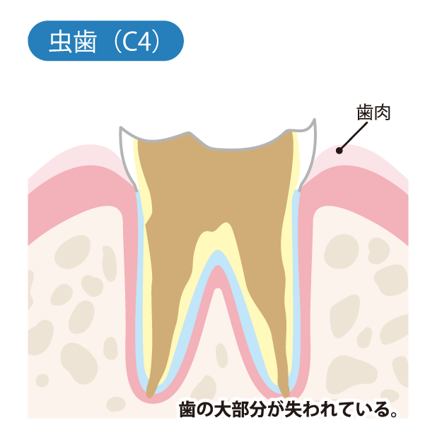虫歯（C4）